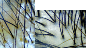Hair scans in beechoo