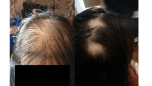 Example of diffused versus patchy hair loss