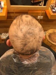 Chemical dyes hair loss