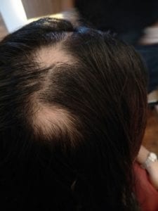 Customer suffering from Alopecia Areata