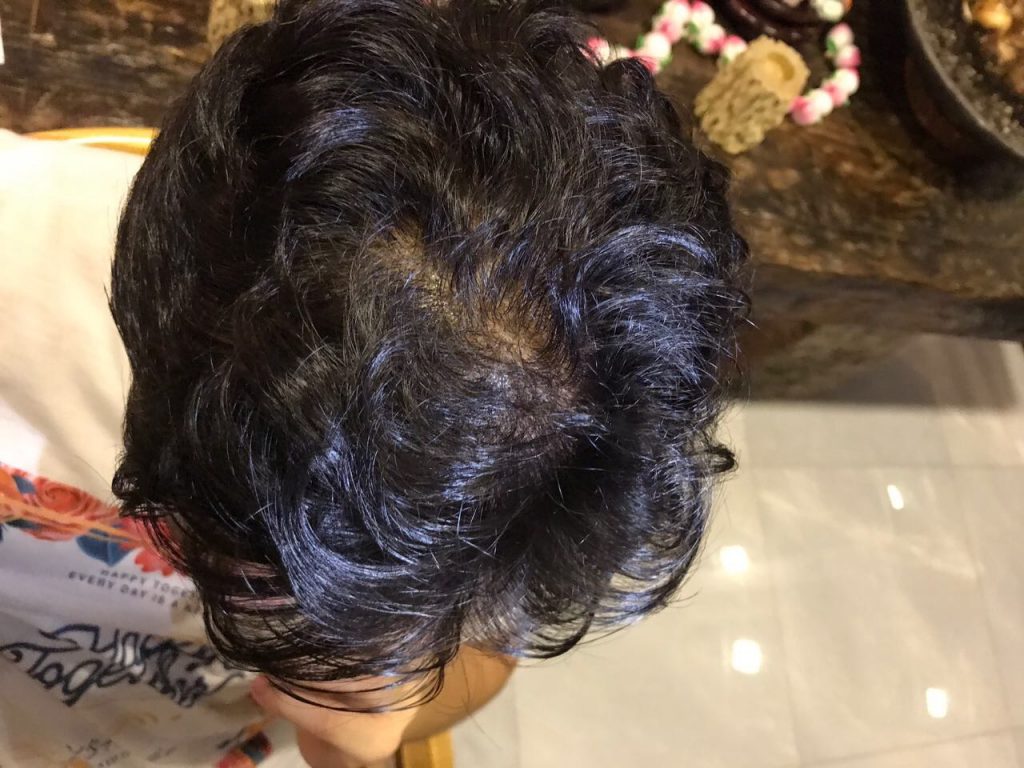 Man with oily scalp