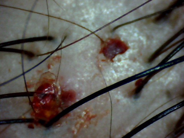 Hair scan of an oily, damaged scalp