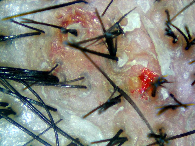 Oily scalp hair scan