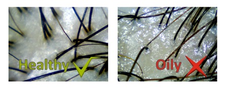 Example of an oily scalp hair scan