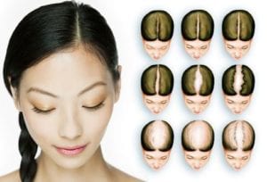 5 Types of Hair Loss Patterns in Females and Reversible Treatment
