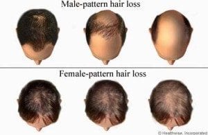 Male and female pattern baldness comparison