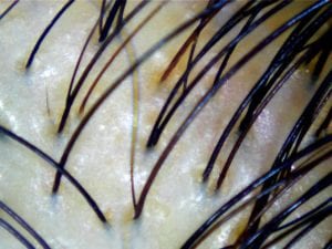 Early signs of hair loss. 1-2 hairs per pore