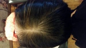 Example of early stage female hair loss pattern