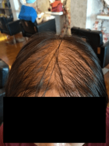 Example of advanced stage female hair loss pattern