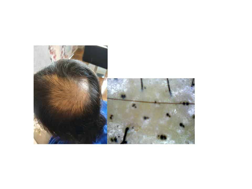 Example of hair loss due to bacterial infection