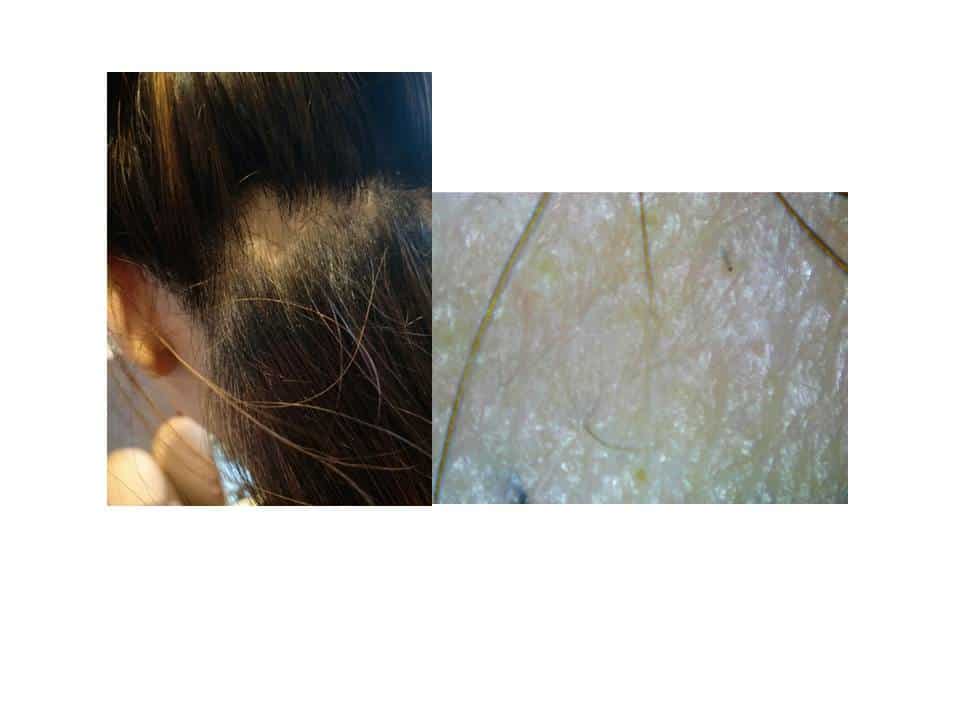 Example of hair loss due to alopecia areata