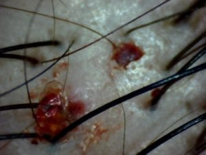 hair scan scratched scalp