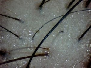 Oily and unhealthy scalp