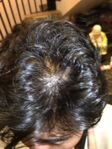 Me, before scalp management