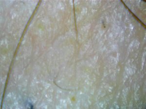 Alopecia Areata hair scan