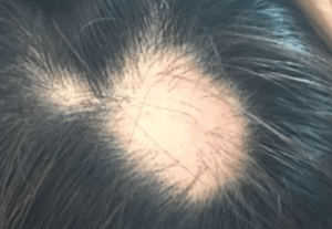 Alopecia Areata, a condition whereby the body immune system attacks your own hair follicles