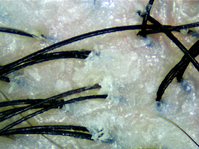 Dry Scalp