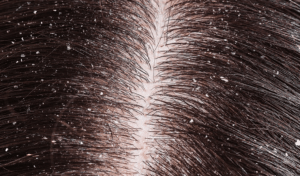 Why is my Scalp Dry and what are ways to combat it?