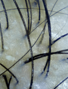 Dandruff caused by dry scalp