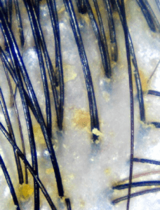 Dandruff caused by excess oil