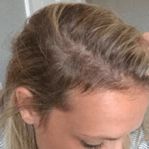 Is Hair Loss Normal After Giving Birth And Can I Find Treatment In Singapore?