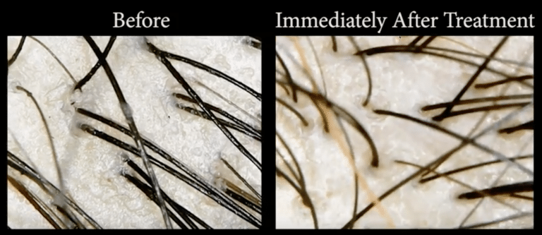 Hair scanning showing dandruff and clogged hair follicles