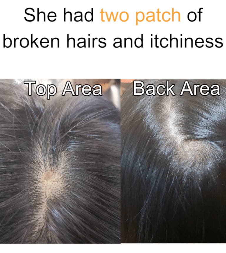 Effective treatment to get rid of patchy hair loss and itchy scalp