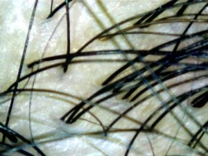 itchy scalp after scalp management with bee choo