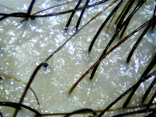 hair scan showing very oily scalp bee choo ladies