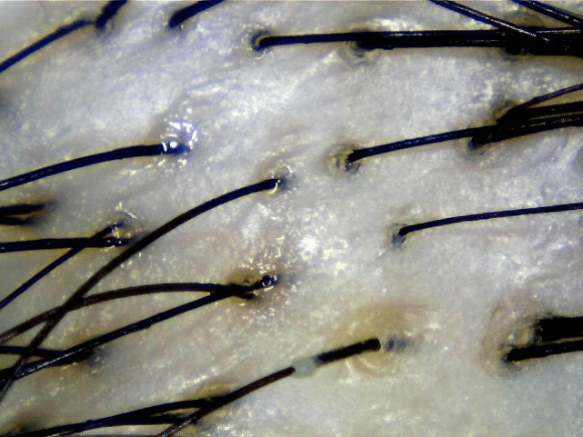 Hair Scan showing slightly oily scalp - Credits Bee Choo Ladies