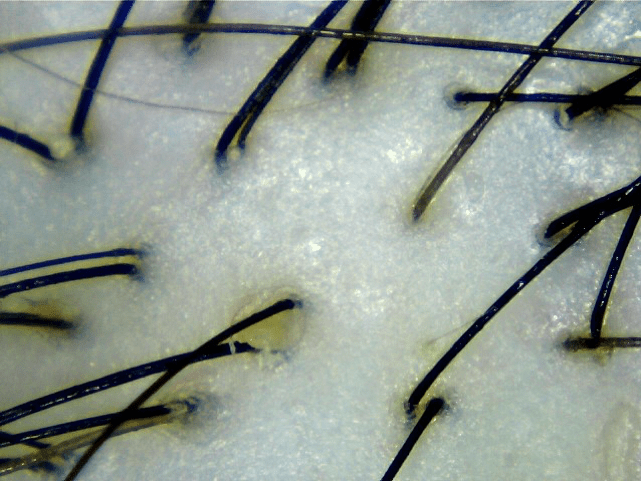 Hair Scan showing normal scalp - Credits Bee Choo Ladies