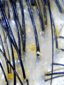 Yellow dandruff caused by an oily scalp