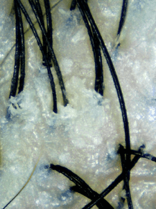 Dandruff caused by oiliness (yellow) vs Dandruff caused by Dryness (white)