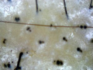 Our Customer’s recovery from scalp infection