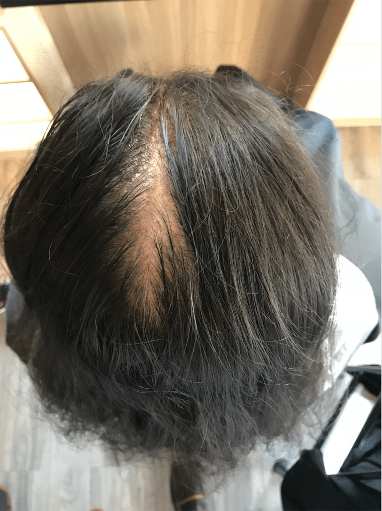 Successful Hair Loss Testimonial for effective Scalp treatment, pain-free, natural and cheap