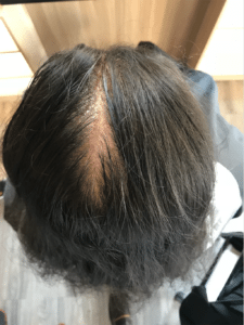 Hair before Bee Choo treatment