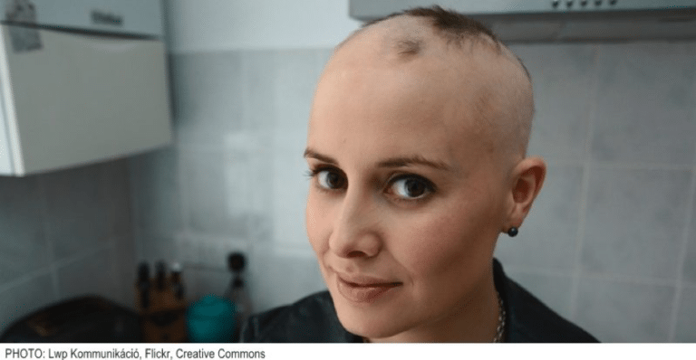 Suffering from alopecia hair loss? Learn more about treatment for women in Singapore