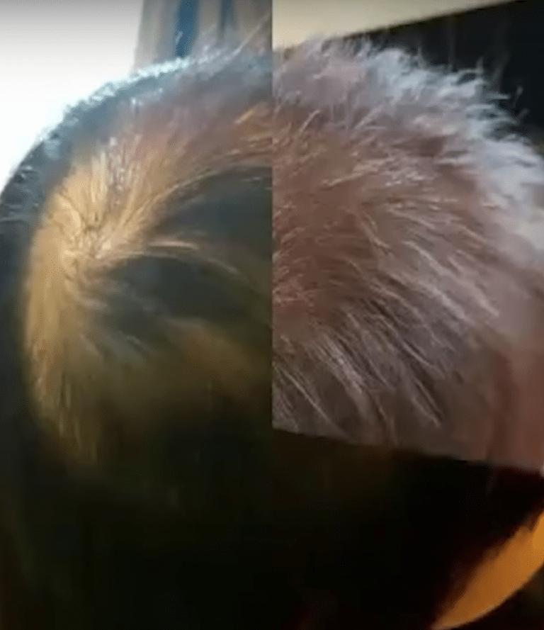Amazing Recovery Treatment from Severe Hair Loss due to Fungal Hair Infection