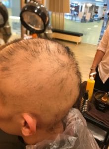 Hair loss due to chemical dye