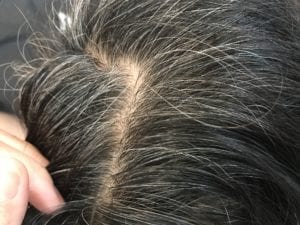 Greying of hair