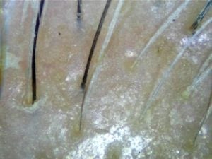 White or grey hair at young age? Reverse it to black with treatment!