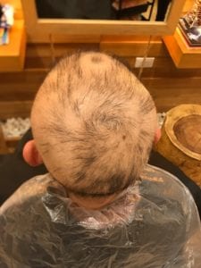 Man, in his thirties, lost all his hair 1 month after dyeing his hair blonde, photo taken by Bee Choo Origin