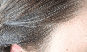 Why is my hair turning white when I am in my 20s? How to prevent or reverse it in Singapore?