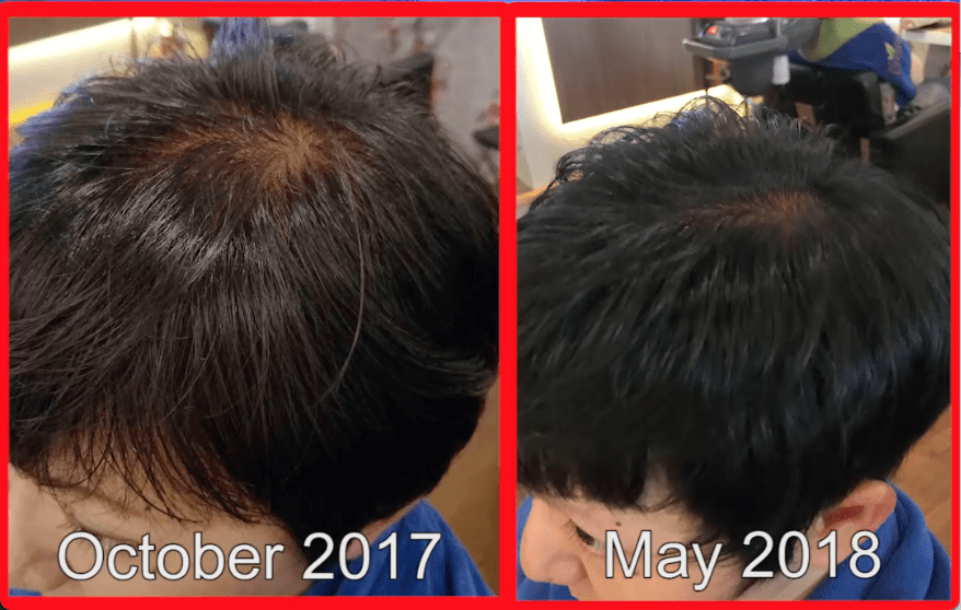Best Hair Loss Treatment Singapore Review — Allanna before and after treatment