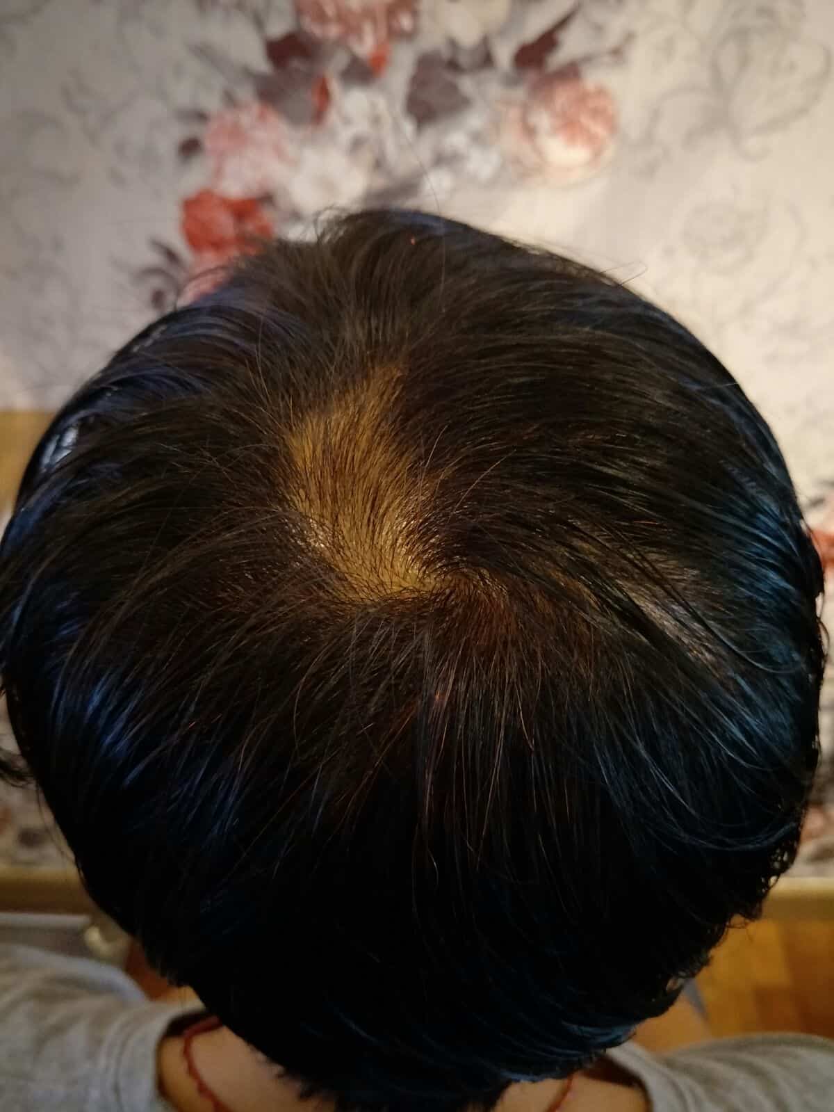 Effective Hair Loss Treatment in Singapore (2)