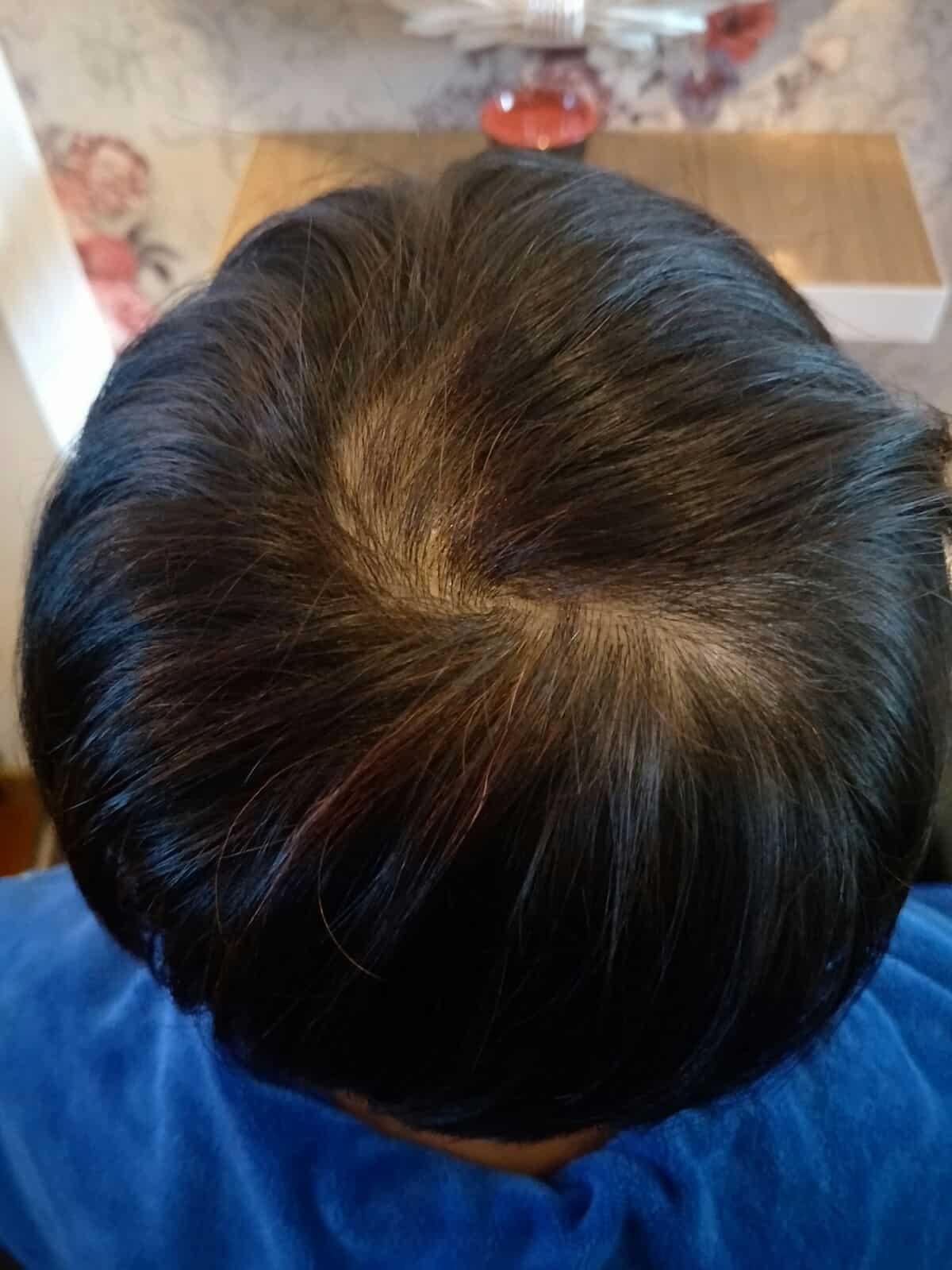Effective Hair Loss Treatment in Singapore (3)