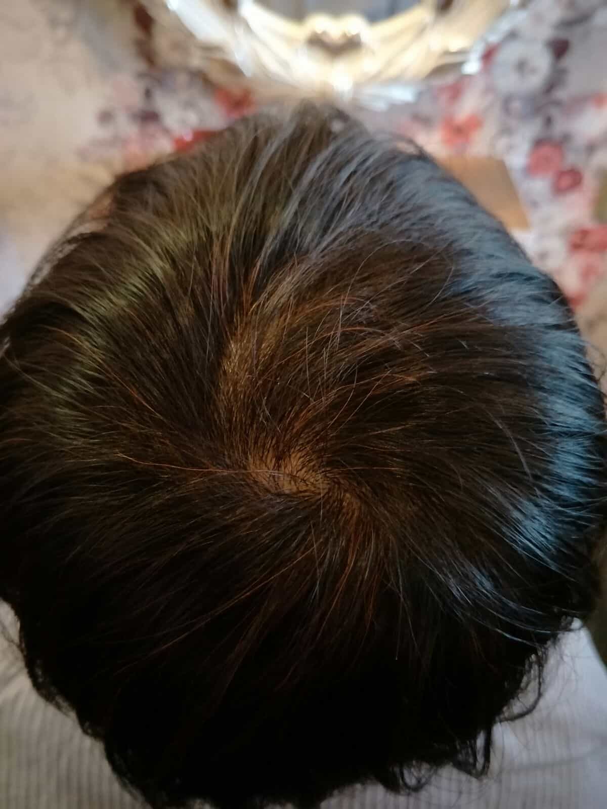 Effective Hair Loss Treatment in Singapore (5)