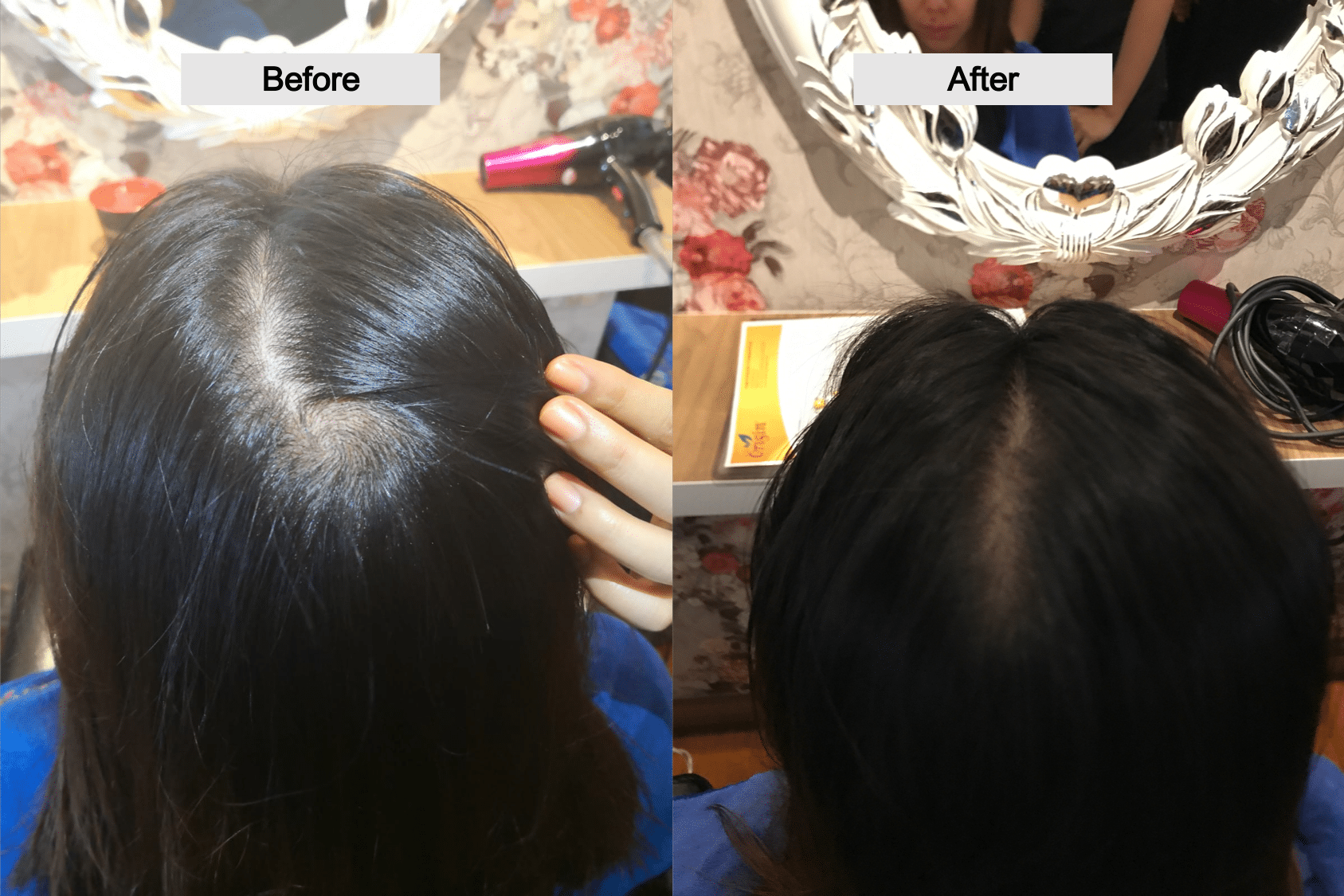 Effective Hair Loss Treatment in Singapore (before after)