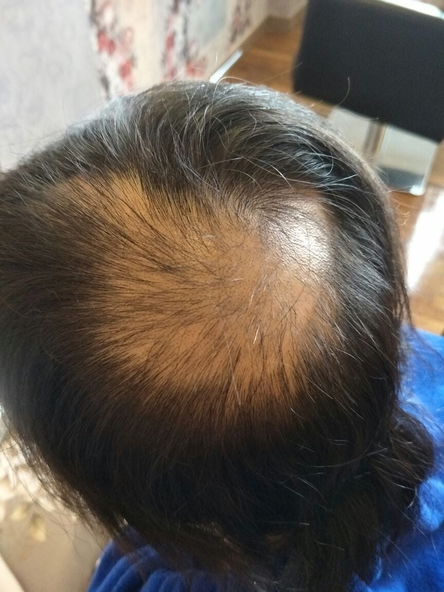 Effective Hair Loss Treatment in Singapore (trixie3)