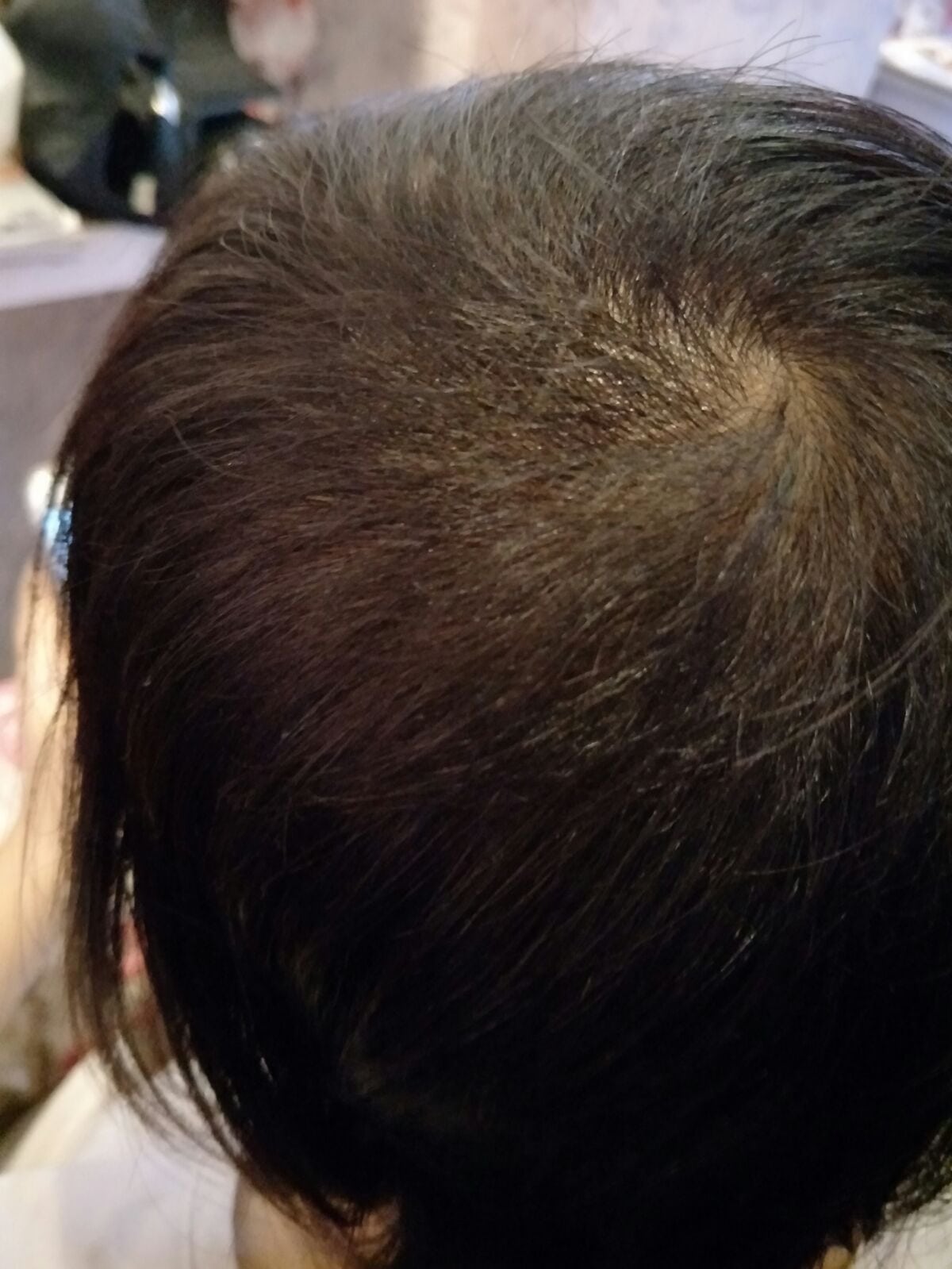 Effective Hair Loss Treatment in Singapore (trixie5)